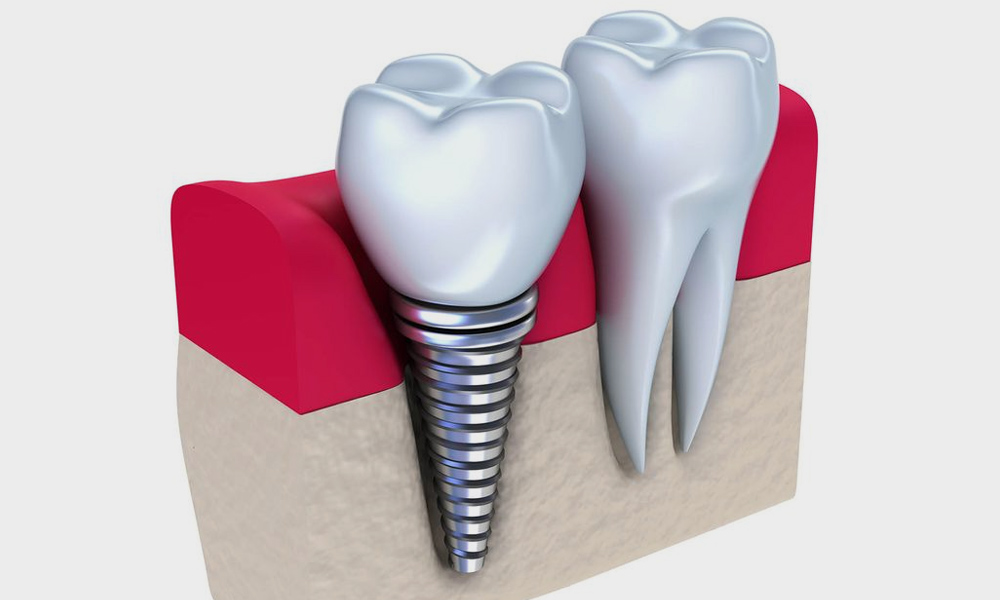 the dental implant timeline what to expect from your treatment process