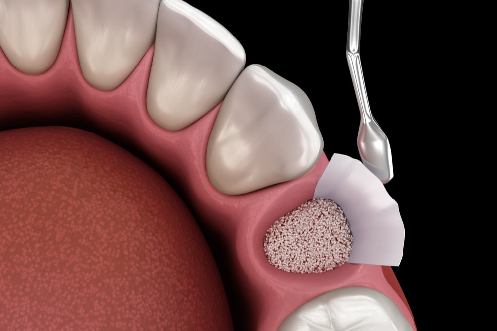 bone grafting in dacula